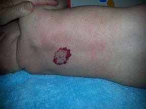 Birth mole on baby's back