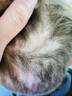 Alopecia Areata