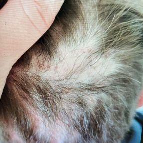 Pelade (alopecia areata)