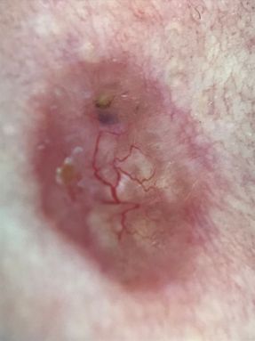 Basal cell carcinoma dermoscopy