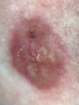 Tyvisolusyöpä dermatoskopia