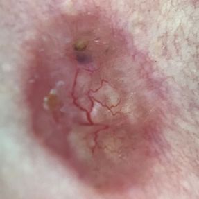 Cancer de la peau (basaliome) dermatoscopie