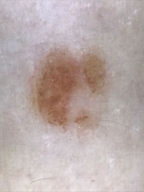Dysplastic mole