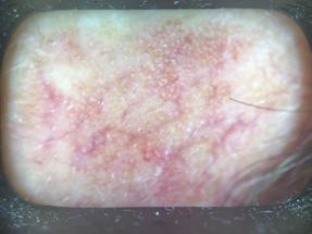 Actinic keratosis dermoscopy