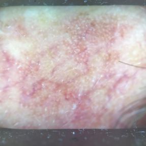 Kératose actinique (KA) dermatoscopie