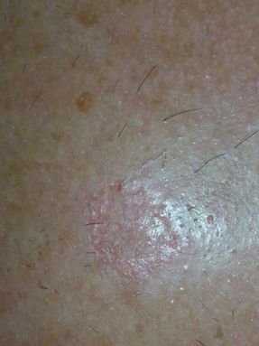 Solar keratosis on the scalp