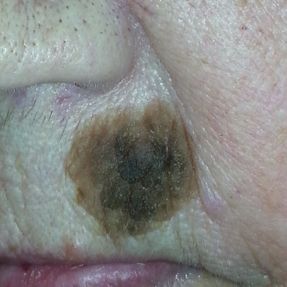 Large verrue séborrhéique sur le visage