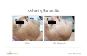 Intense pulsed light (IPL) treatment before and after