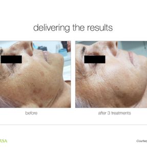 Traitement IPL par lumière pulsée intense
