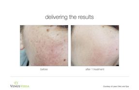 Intense pulsed light (IPL) treatment before and after