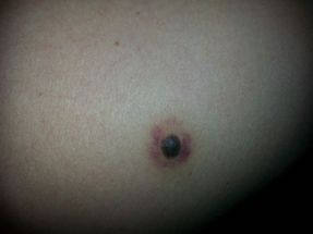 Skin melanoma