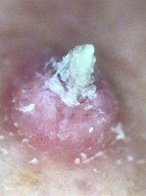 Skin cancer dermatoscopy