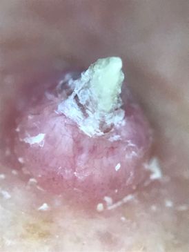 Ihosyöpä dermatoskopia
