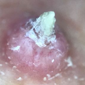 Cancer de la peau dermatoscopie