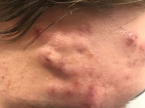Acne conglobata (AC) on the forehead