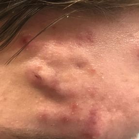 Acne conglobata (AC) on the forehead