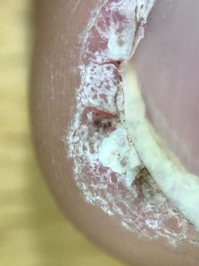 Warts on the edge of the nail