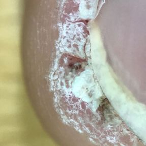 Warts on the edge of the nail