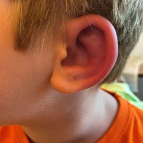 Impetigo dans l’oreille d’un.e enfant