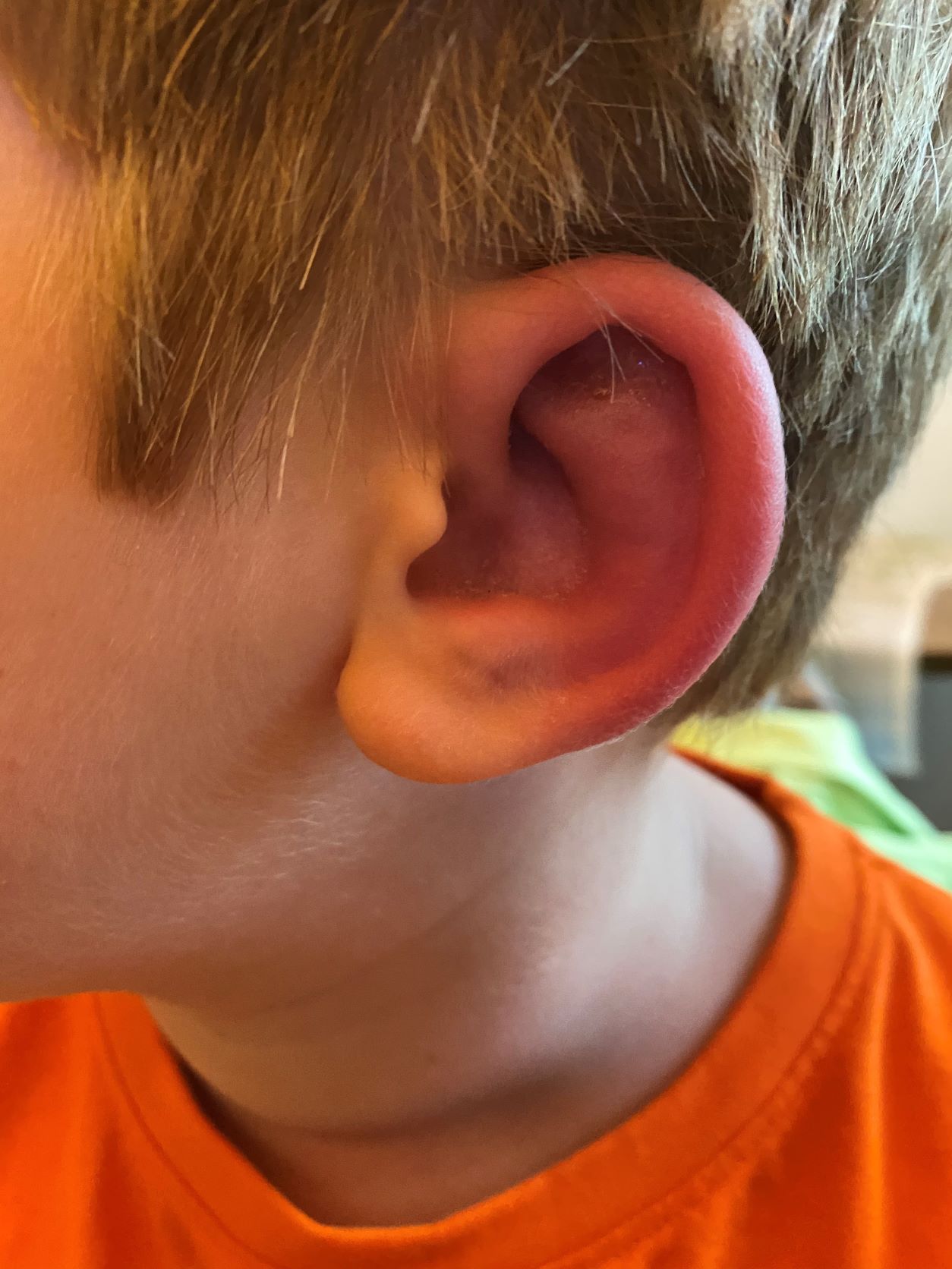 Impetigo in a child's ear