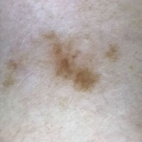 Grain de beauté et dépigmentation de la peau