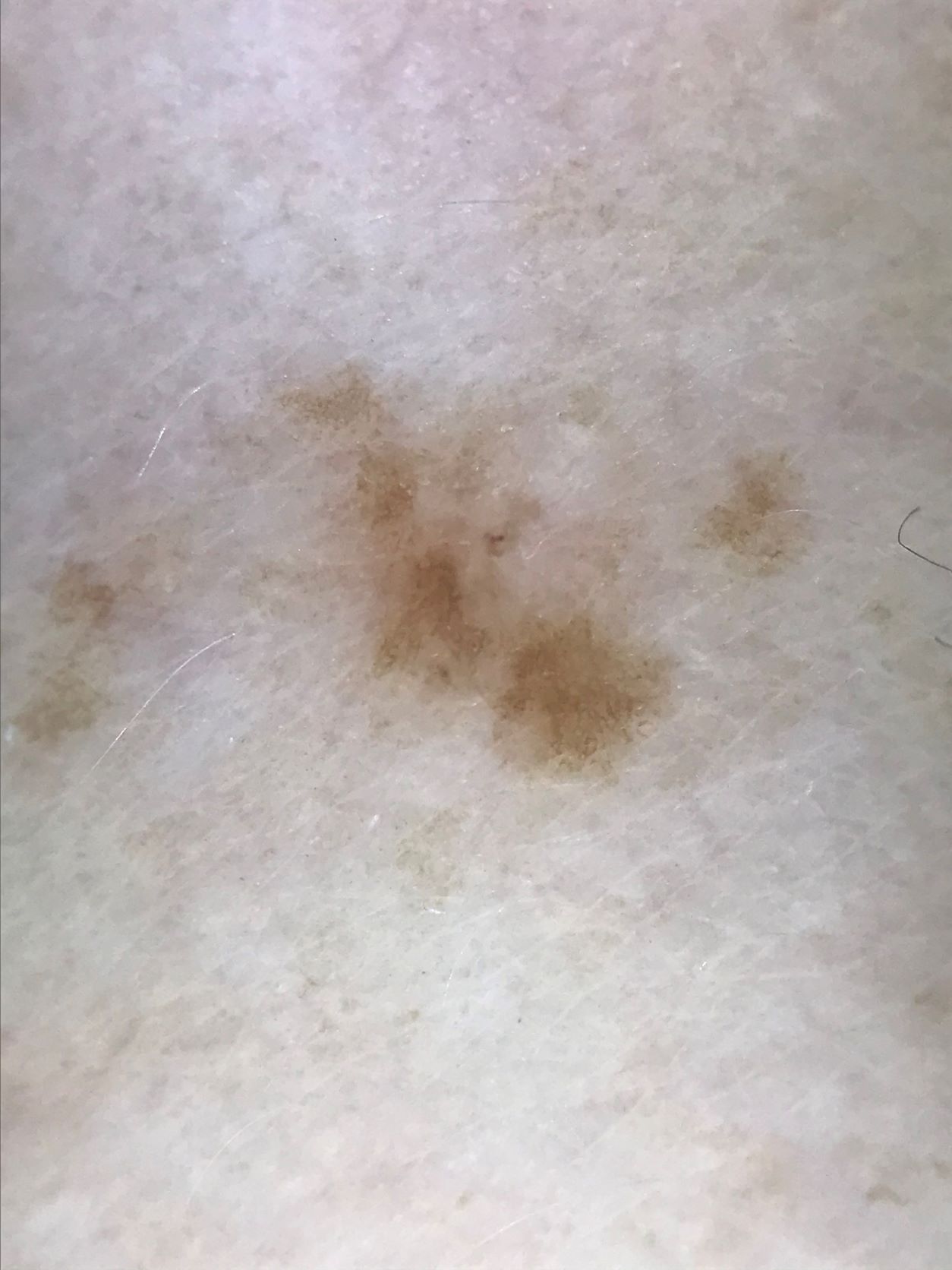 Mole and depigmentation