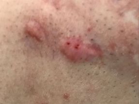 Acne and post-acne marks