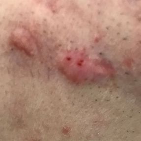 Acne and post-acne marks