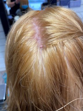 Annoying mole in the scalp
