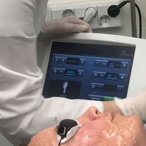 Traitement IPL par lumière pulsée intense