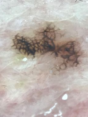Dysplastic mole