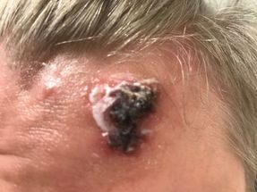 Damage due to self-treatment